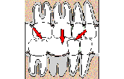 Удаление зубов (даже одного) может создать серьёзные проблемы с жеванием